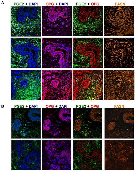 OPG, FASN and PGE2 expression is significantly elevated in patient invasive breast cancer tissue.