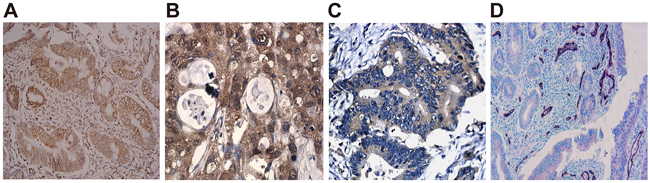 ANRIL expression positively relates to lymphangiogenesis-related factors and LMVD in surgical specimens.