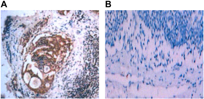 Lymph node metastasis in the mice with transplanted colon tumor detected with immunohistochemistry and CK antibody after transfection with sh-ANRIL.
