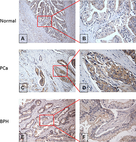 Evaluation of RalA protein expression in normal, PCa and BPH prostate tissue by immunohistochemistry.