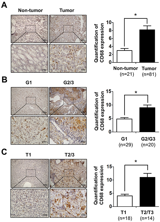 Infiltrating macrophages is positively related to RCC patients&#x2019; tumor stage and grade.