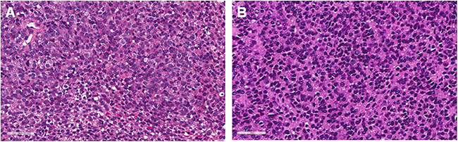 Histological comparison between patient original tumors and a PDOX tumor.