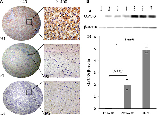 GPC-3 expression and cellular distribution between HCC and noncancerous tissues.