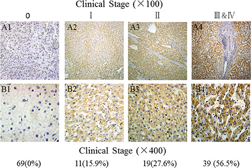 Comparative analysis of GPC-3 expression in HCC tissues at different stages.