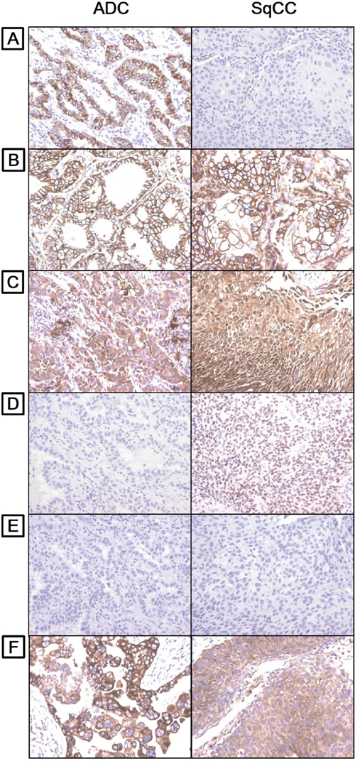 Distinct expression patterns of CSC markers in lung adenocarcinoma and squamous cell carcinoma.
