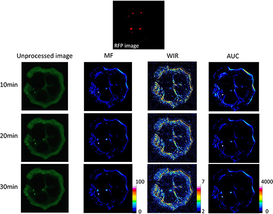 Unprocessed images and kinetic maps (MF, WIR, and AUC maps) using 5 &#x03BC;M gGlu-HMRG, and RFP image (the standard of reference for cancer location).