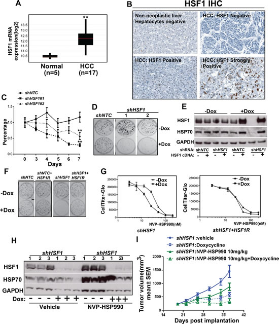 HSF1 knockdown sensitizes hepatocellular cancer cells to HSP90 inhibitor