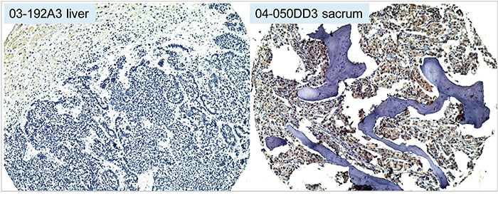 Prostate cancer metastasis expression of AGR2.