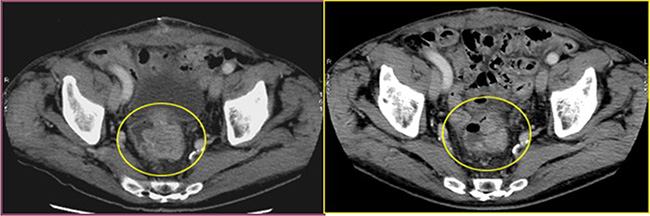 Cross section of contrast enhanced CT scan of the pelvis (venous phase).