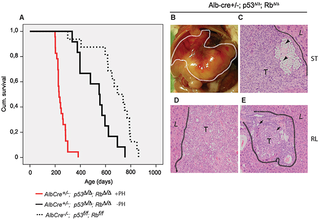 Hepatic resection in Alb-cre&#x002B;/-; p53&#x0394;/&#x0394;; Rb&#x0394;/&#x0394; mice results in reduced survival and undifferentiated carcinomas at the ligation site.