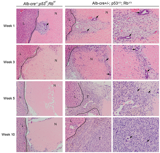 RFA in Alb-cre&#x002B;/-; p53&#x0394;/&#x0394;; Rb&#x0394;/&#x0394; mice leads to expansion of bile duct cells and formation of liver tumors at the injury site.