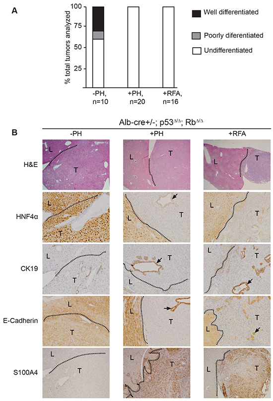 Surgical resection or RFA in Alb-cre&#x002B;/-; p53&#x0394;/&#x0394;; Rb&#x0394;/&#x0394; mice lead to formation of undifferentiated carcinomas that underwent epithelial-mesenchymal transition.