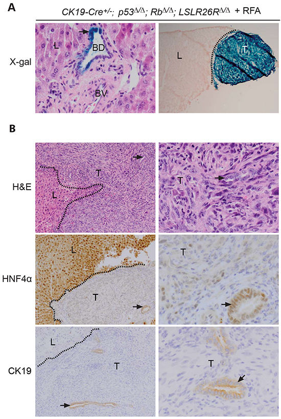 Cholangiocyte specific deletion of p53 and Rb in mice leads to undifferentiated carcinomas at the RFA injury site.