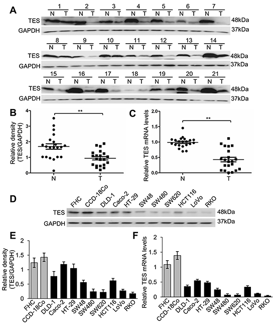 Loss of TES expression in CRC tissues and cell lines.