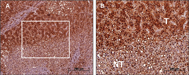 Immunohistochemical analysis of wk-MTA1 expression in tumor and nontumor cells of liver tissues.