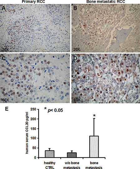 c-MET and CCL20 expression in human samples.