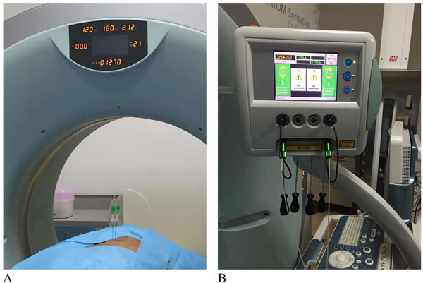 CT-guided percutaneous laser ablation of metastatic lung cancer