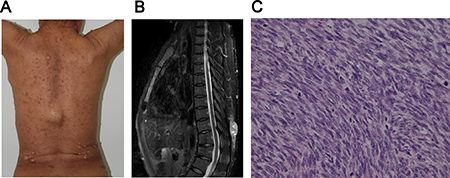 metastatic melanotic peripheral nerve sheath sarcoma prognosis Pathology Outlines main image 1